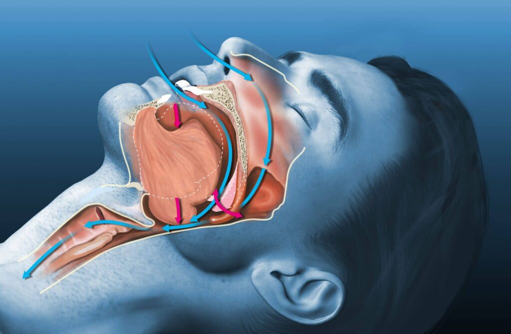 Sleep Apnea Tests